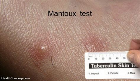 mantoux test positive result images